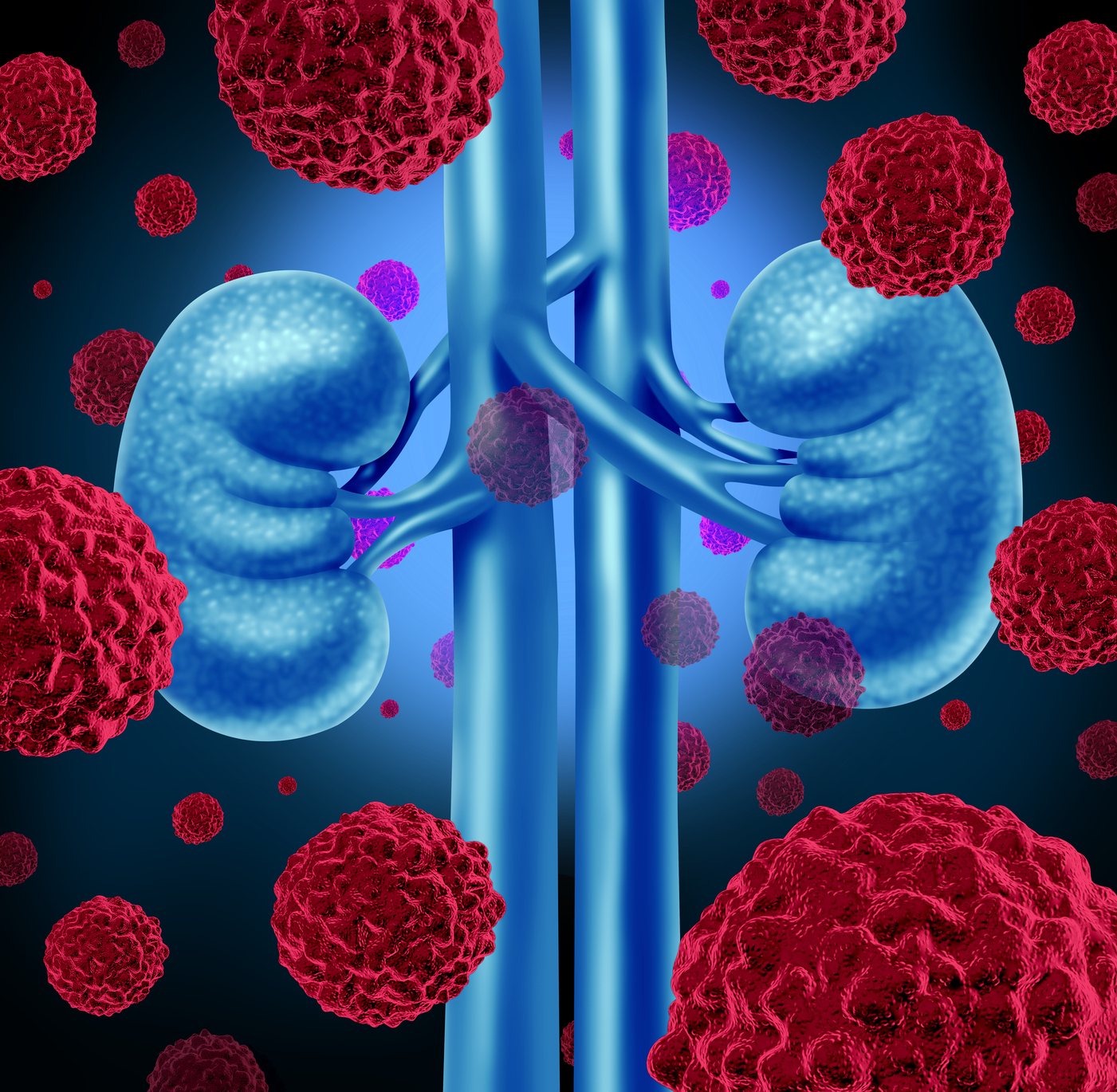 kidney cancer