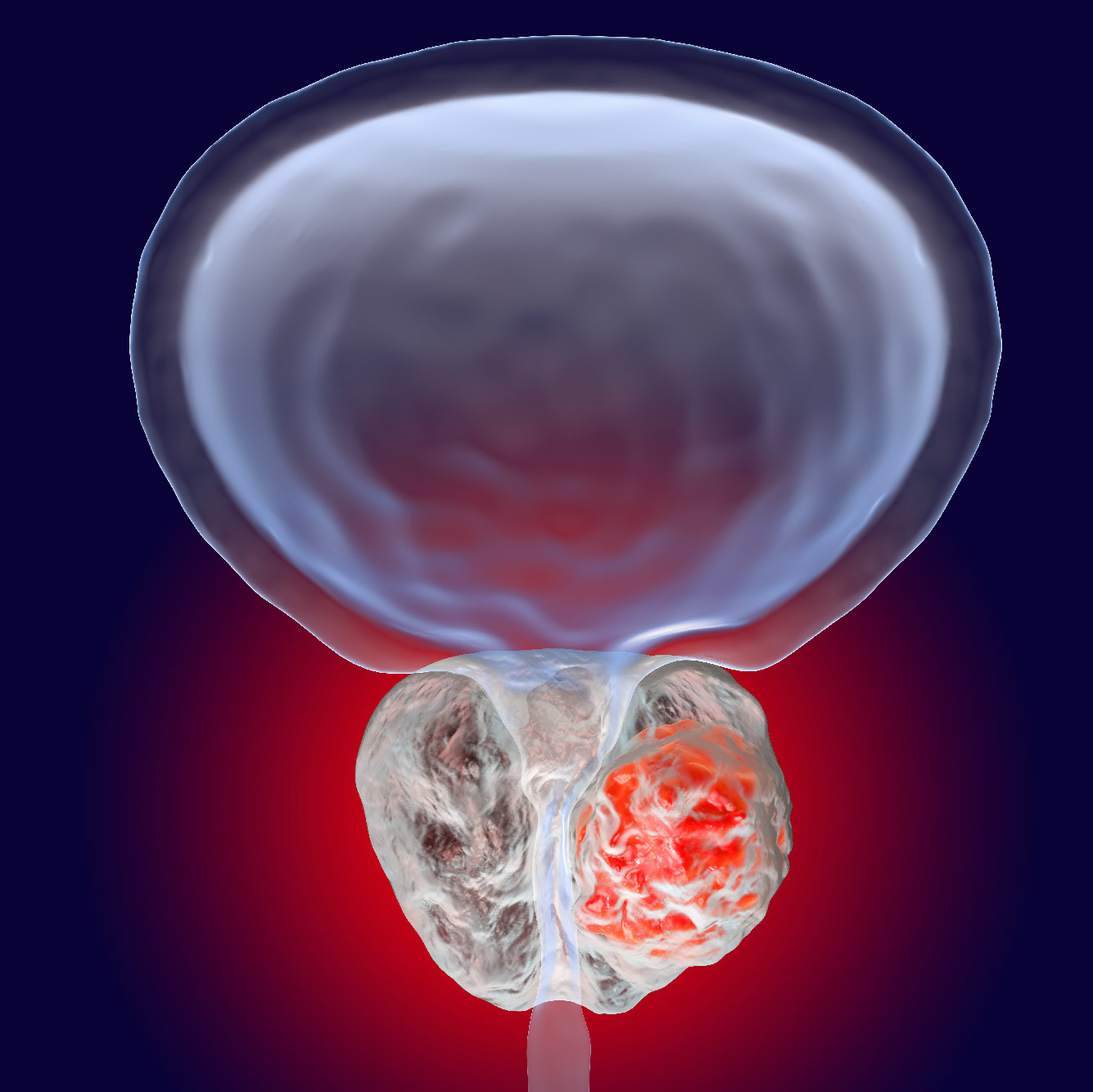 A prostate infected with cancer