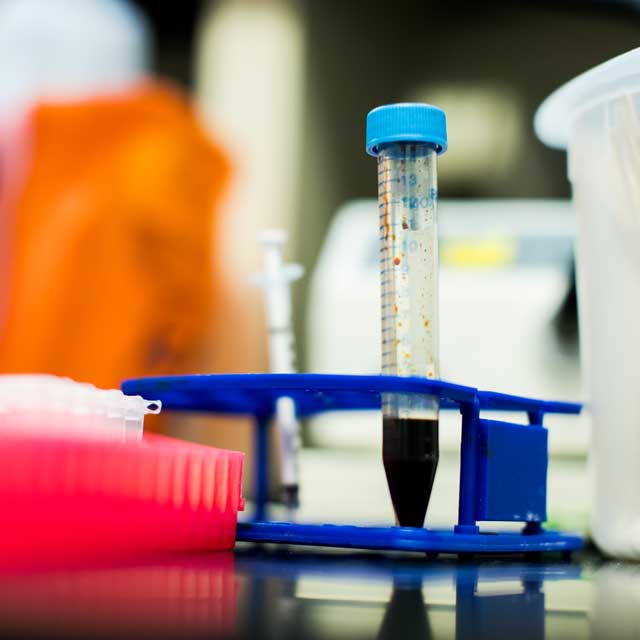 urologic blood sample in tube