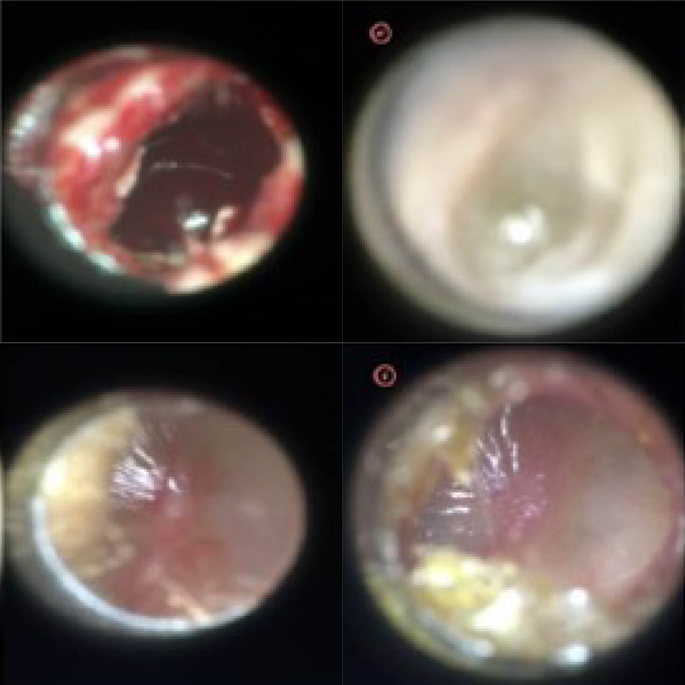 A photo shows four images of ear drums. 