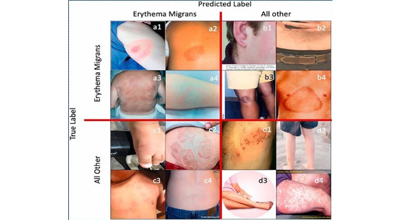 Erythema Migrans Stock Photos Erythema Migrans Stock
