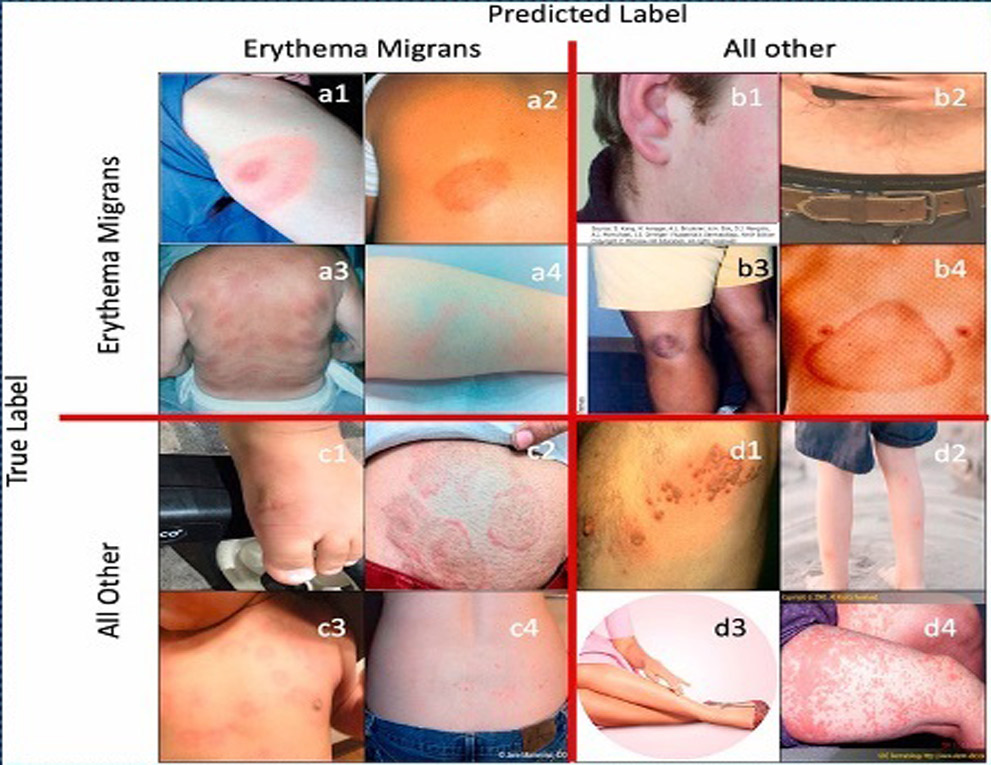 erythema migrans