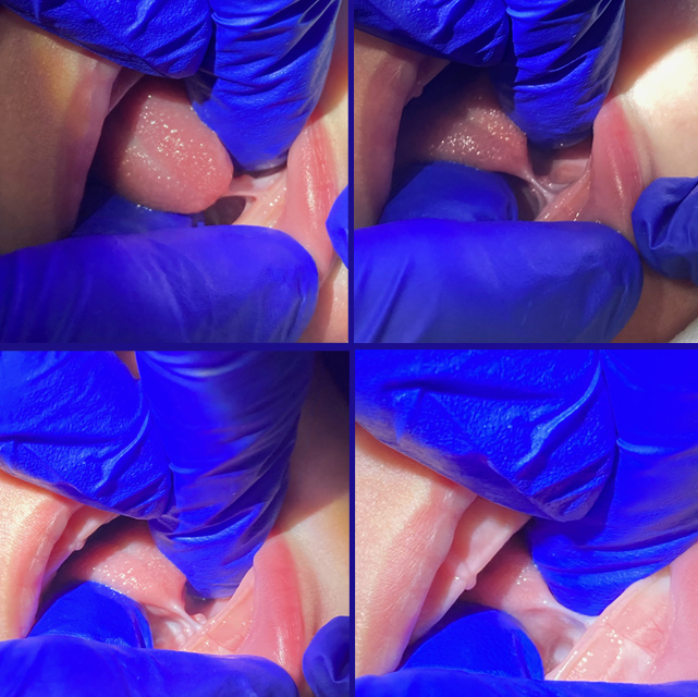 A group of photos shows tongue-tie.