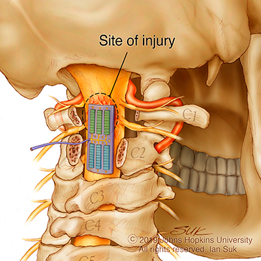 Illustration for the site of surgery at the base of the skull.