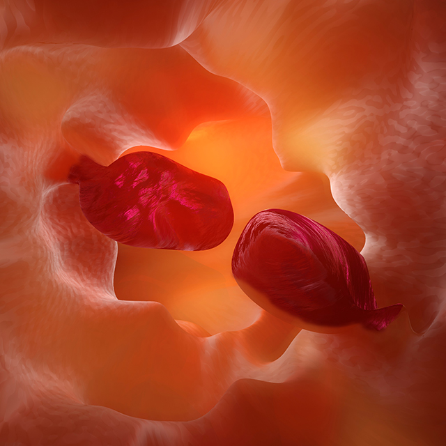 A digital rendering of two gastrointestinal polyps shows two red protrusions in the intestinal tract.
