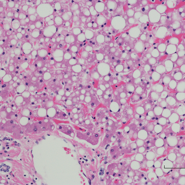 Image shows macrovesicular hepatic steatosis of the liver.