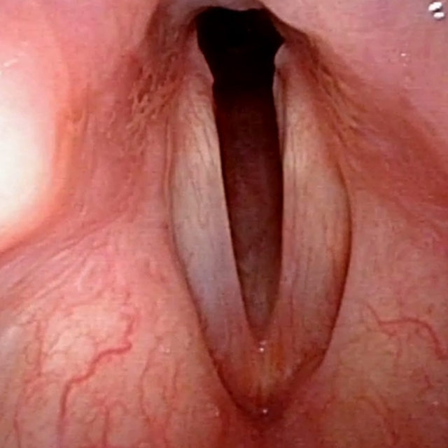 A clinical photo shows an airway after treatment.