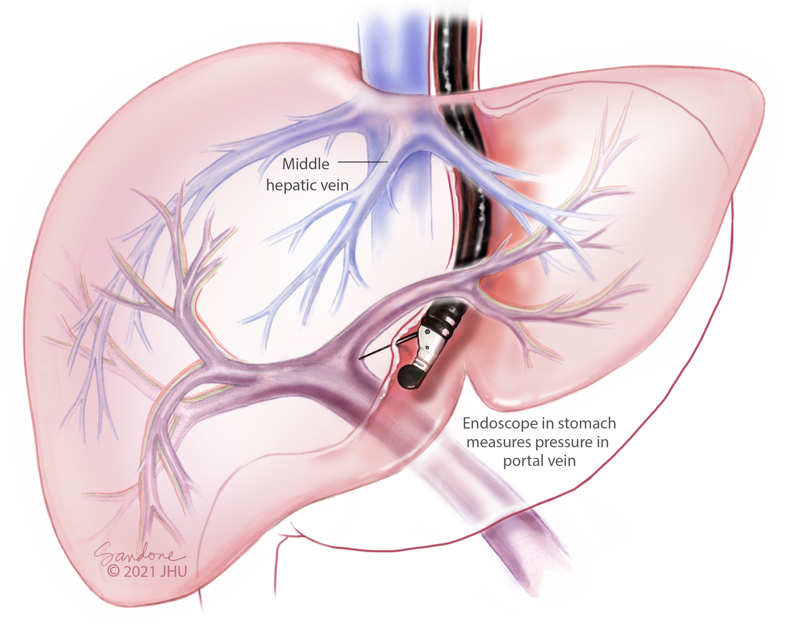 An illustration shows an endoscope in the stomach that measures portal vein pressure.