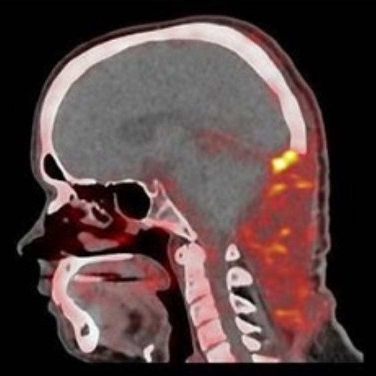 PET scan of head and neck