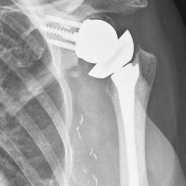 An x-ray of a shoulder after reverse total shoulder arthroplasty.