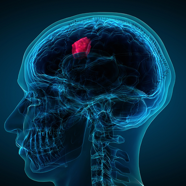 An illustration shows a blue ultrasound-like image of the head and neck, with a brain tumor glowing pink