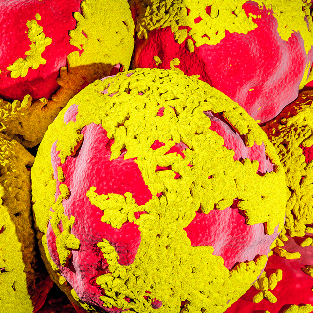 An illustration of cancer cells in an ovarian cyst show spheres with red cores coated partially in yellow