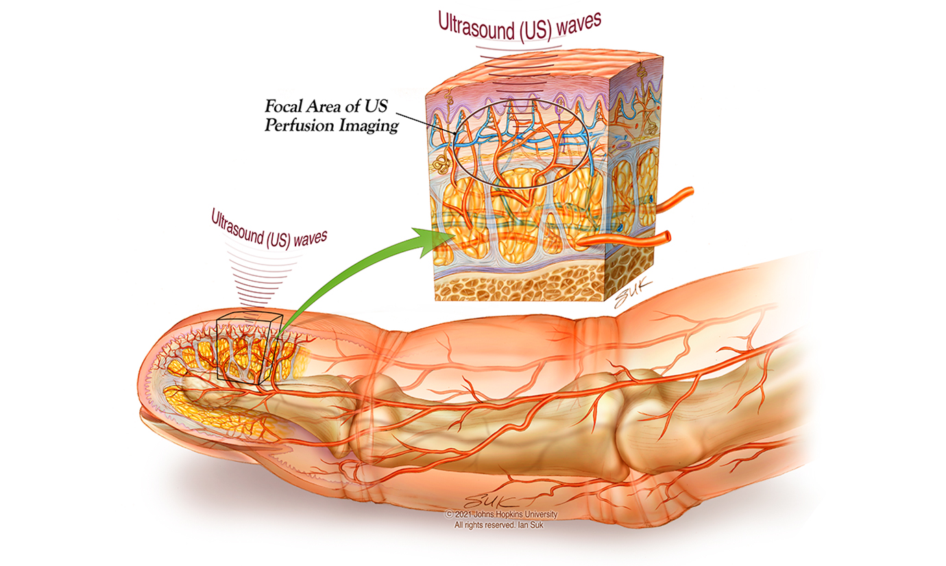 A medical illustration shows the circulatory system inside of a finger, which is used as a model for the small vessels in the spinal cord