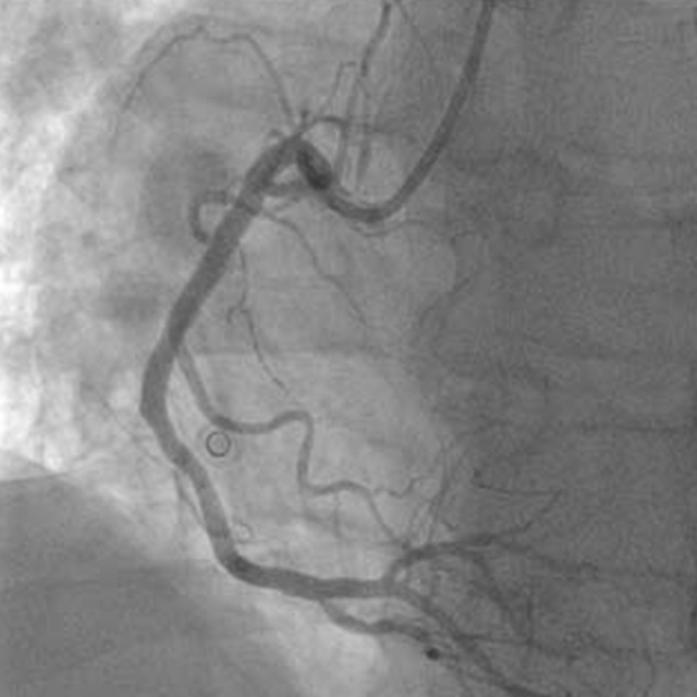 Images show percutaneous coronary intervention. (Getty Images)