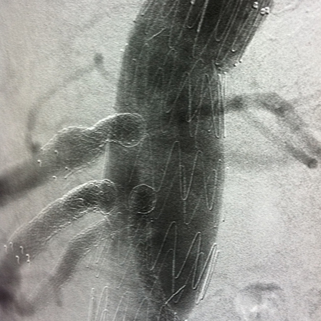 Phot shows placement of stent graft during surgery.