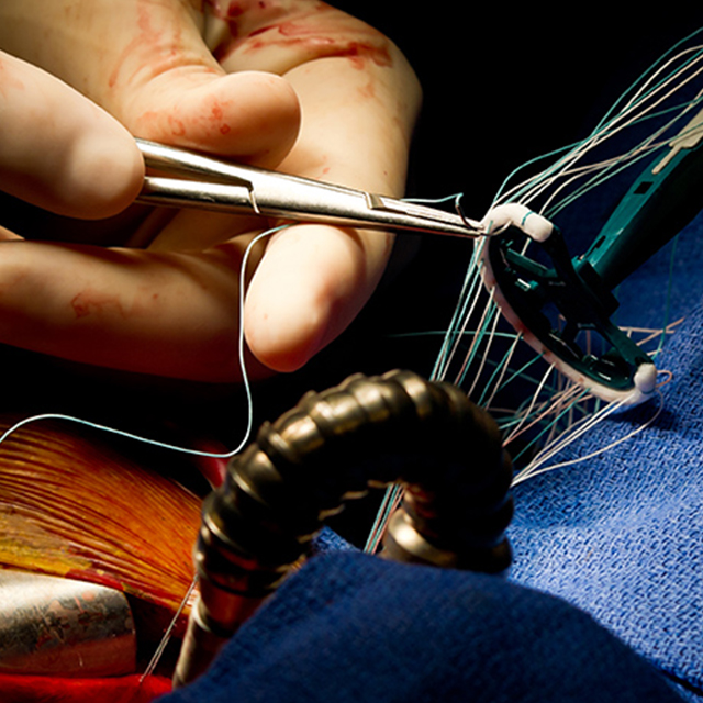 Image of mitral valve surgery.