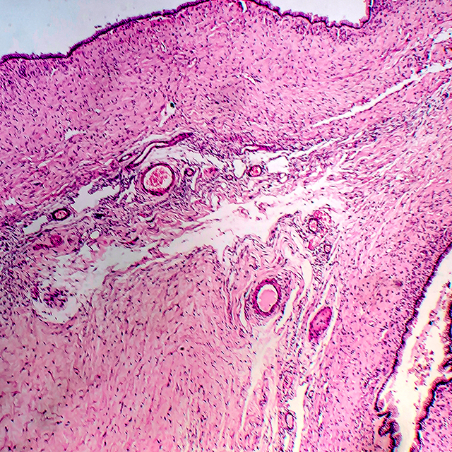 A light micrograph shows an ovarian cyst in pink and purple colors.