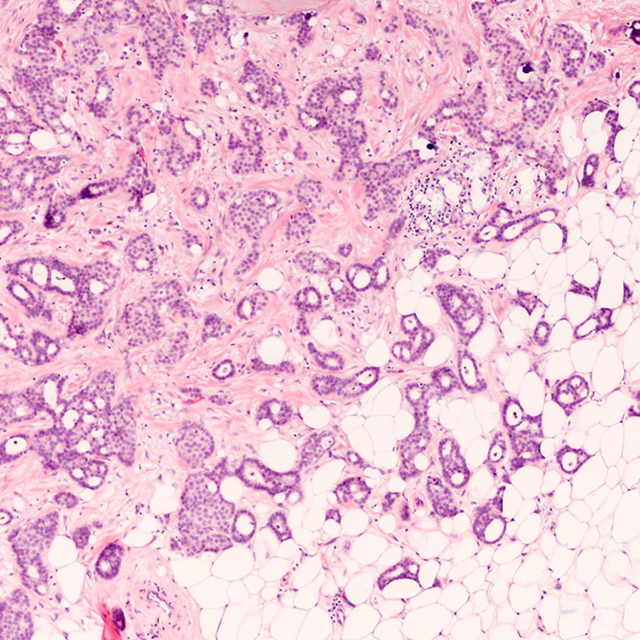 A image shows breast cancer cells under a microscope