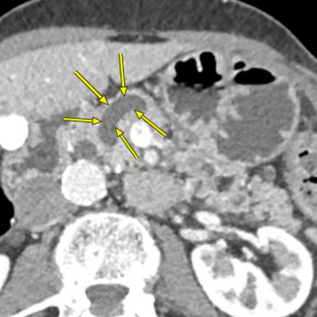 Medical imaging shows an intraductal papillary mucinous neoplasm (IPMN), a dark gray area highlighted by yellow arrows
