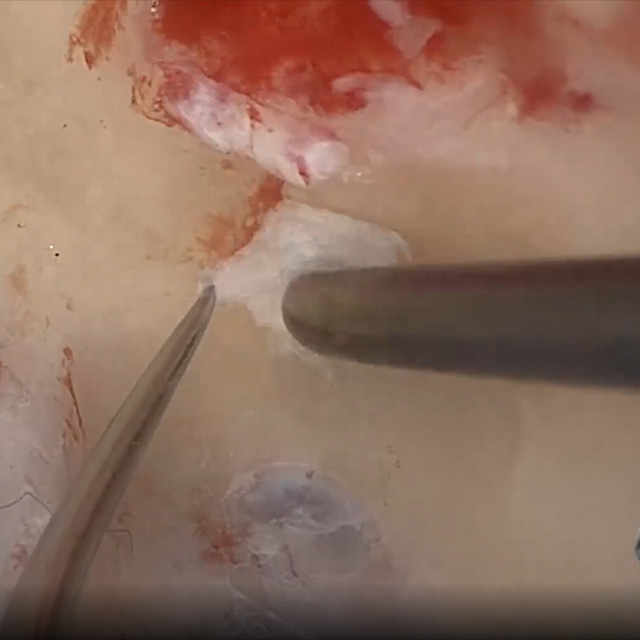 An image shows a new procedure to treat superior canal dehiscence that plugs the posterior limb of the superior canal with fascia underwater.