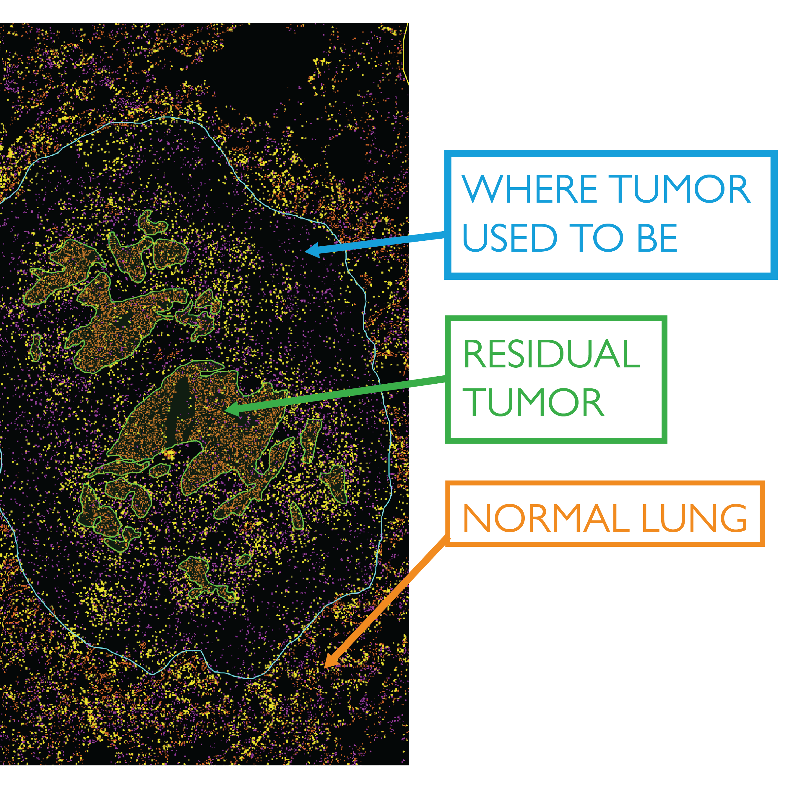An image from the AstroPath platform shows a 70% reduction in tumor size after neoadjuvant therapy prior to surgery.