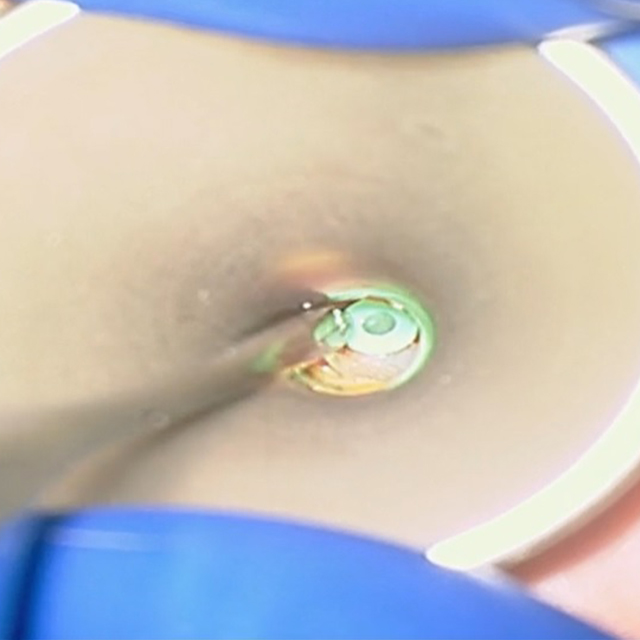 An image shows ear tube placement.