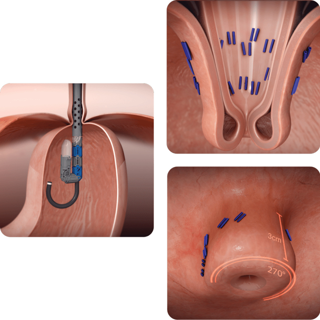 Three images show the steps of a cTIF surgery.