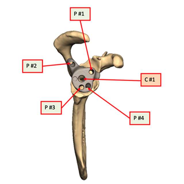 A diagram shows the locations and different screw lengths and types used in a reverse total shoulder arthroplasty.
