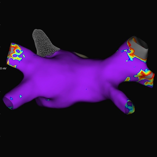 A 3-D reconstruction, the left image demonstrates the electrical activity of the heart prior to ablation and the right image demonstrates how the pulmonary veins have been isolated electrically (grey) from the rest of the heart after ablation. 