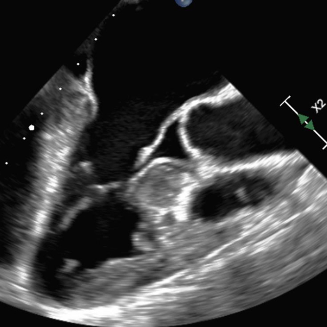 An illustrative mock-up and ultrasound of hypertrophic cardiomyopathy