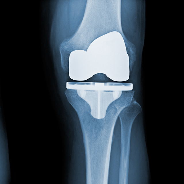 After X-rays of a total knee replacement