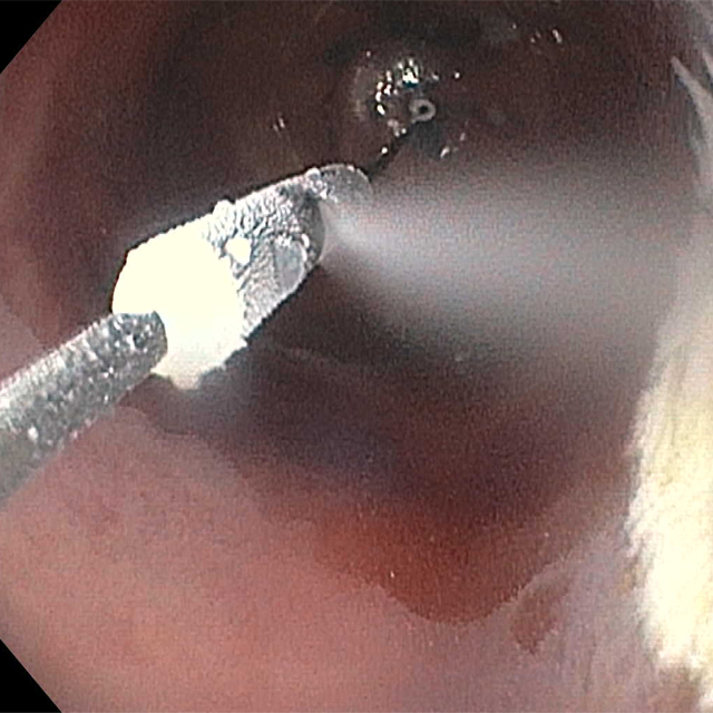 The image is a screenshot taken by Mimi Canto during endoscopic ablation of irregular cells in a case of Barret’s esophagus.