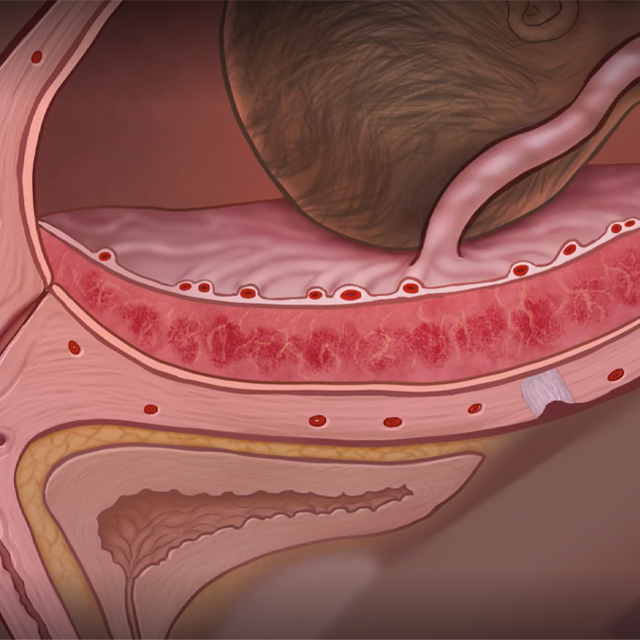A medical illustration depicts placenta accreta, a condition in which placenta grows into the uterus or other nearby organs