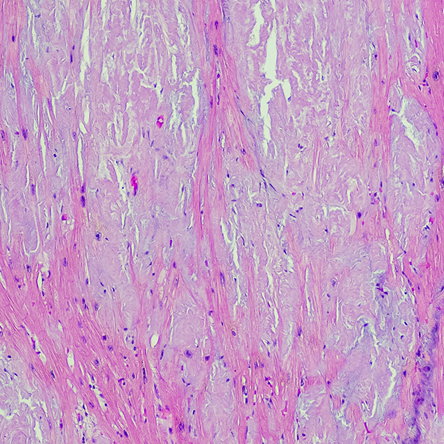 A heart biopsy image shows the faulty protein buildup stained as pink.