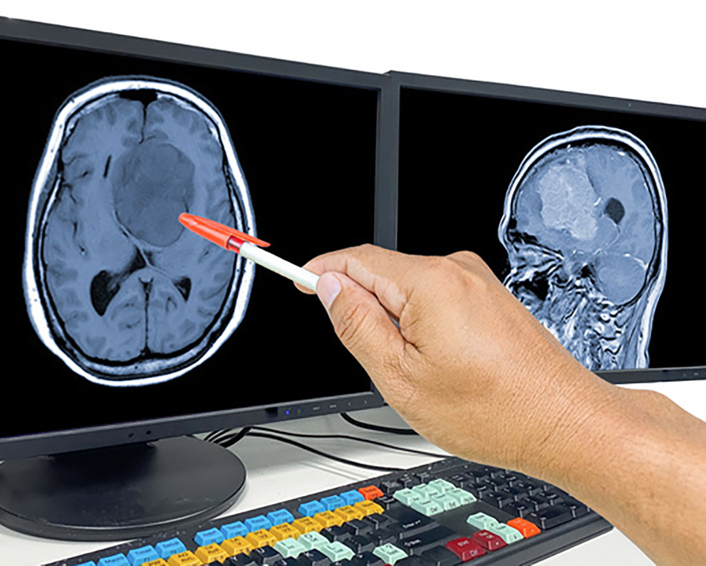 brain tumor