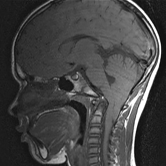 An MRI image shows a large Chiari malformation