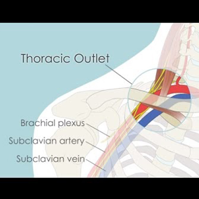 Interior illustration of upper chest area shows location of the thoracic outlet.