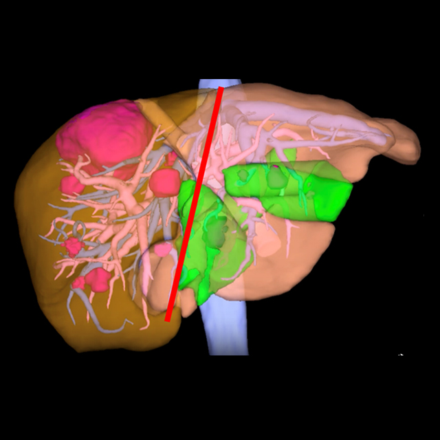 A 3D image shows before and after renderings of the liver of a patient undergoing an ALPPS operation.