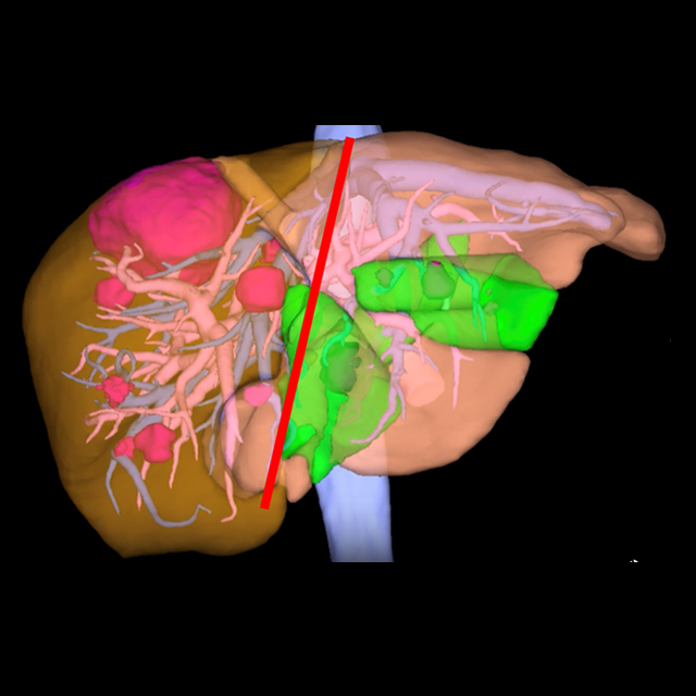 Alpps Surgery Spring 2023 | Johns Hopkins Medicine