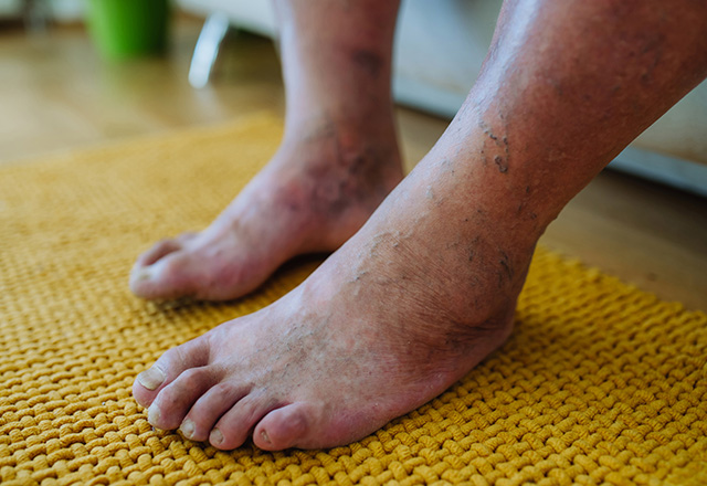 diabetic foot wound