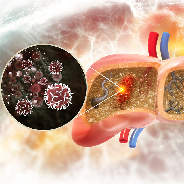 Illustration shows cancer cells on a diseased liver. 