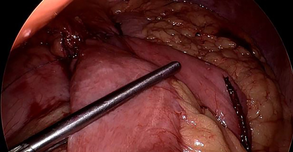 Bariatric surgery laparoscopic grasping