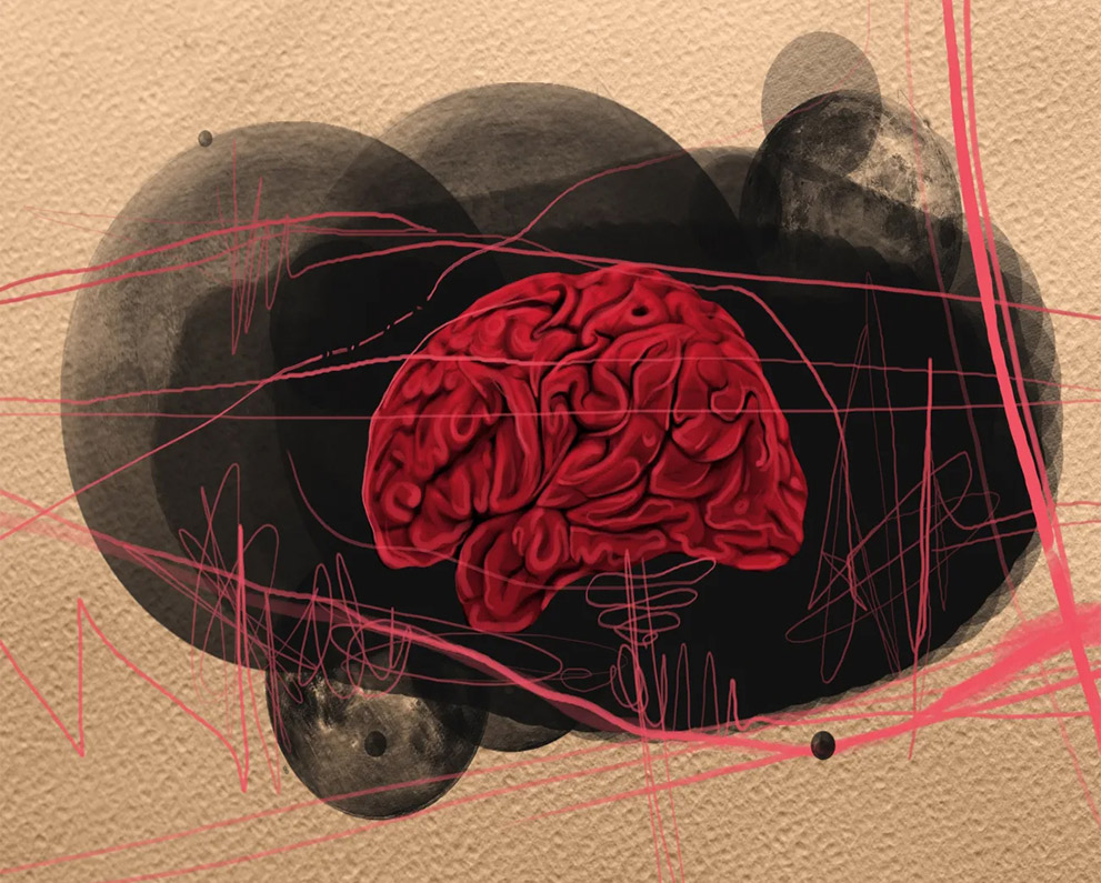 brain stroke