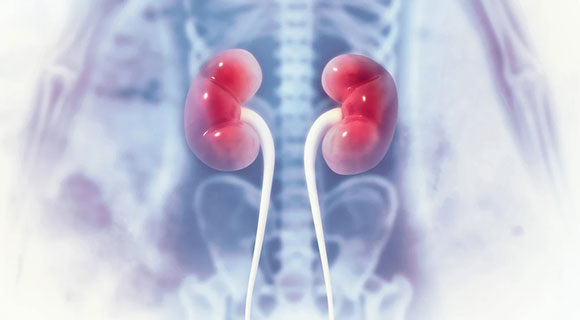 kidney cancer teaser image