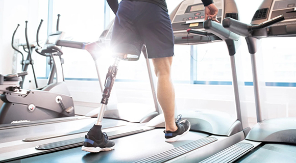 man with prosthetic leg on treadmill teaser image
