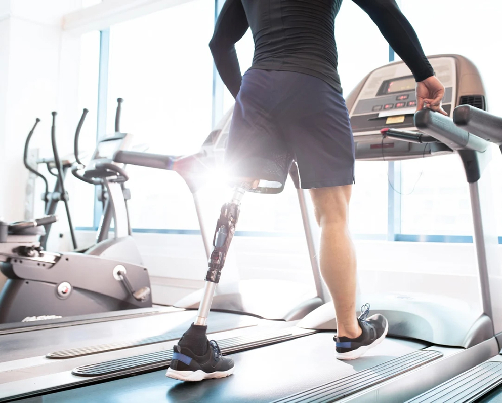 man with prosthetic leg on treadmill