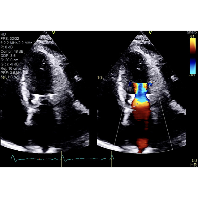 An image of an two ultrasounds side by side. Waves of color appear on the ultrasound to the right. 