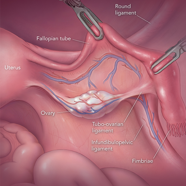 A medical illustration of clamps holding on to a Fallopian tube. 
