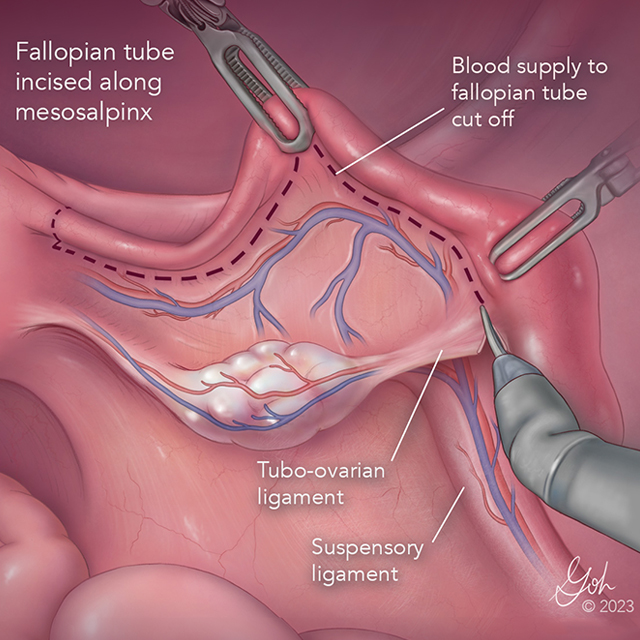 A medical illustration of clamps holding on to a Fallopian tube.