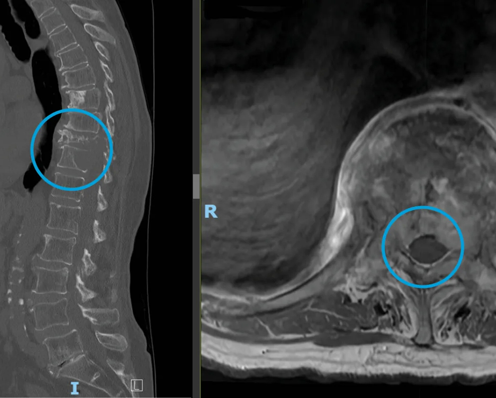 breast cancer metastasized to thoracic spine